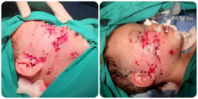 Bé gái 28 tháng tuổi bị chó cắn tổn thương nghiêm trọng vùng mặt