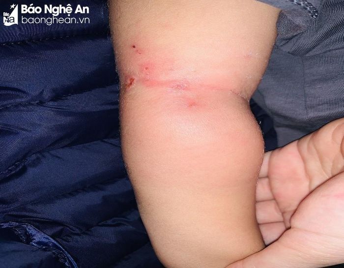 Trẻ bị nhiễm khuẩn huyết từ vết muỗi đốt